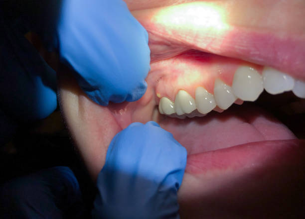 Best Emergency Dental Care for Broken or Chipped Teeth in Pine Prairie, LA